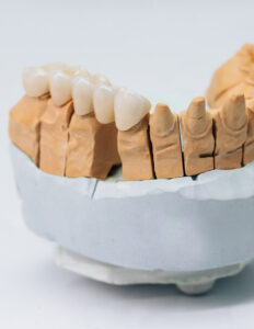 Установка циркониевых коронок