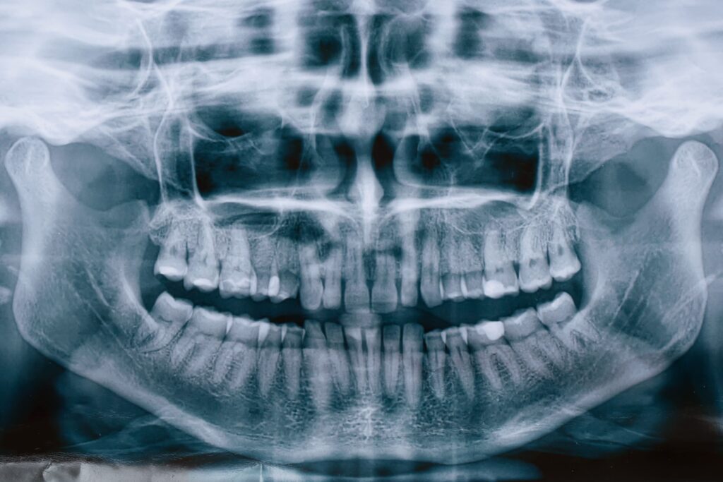 Панорамный снимок зубов