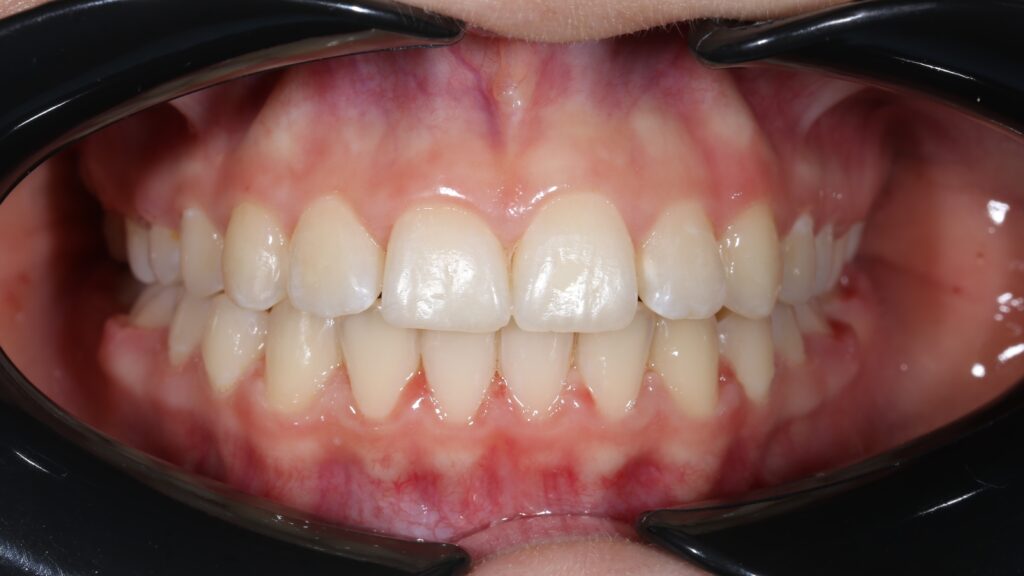 Установка брекет-системы Damon Q на обе челюсти