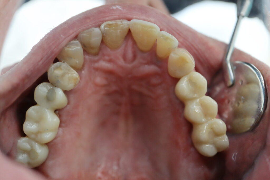 результат протезирования