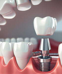 Тотальная имплантация зубов
