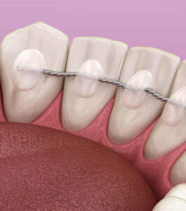 Установка ретейнеров