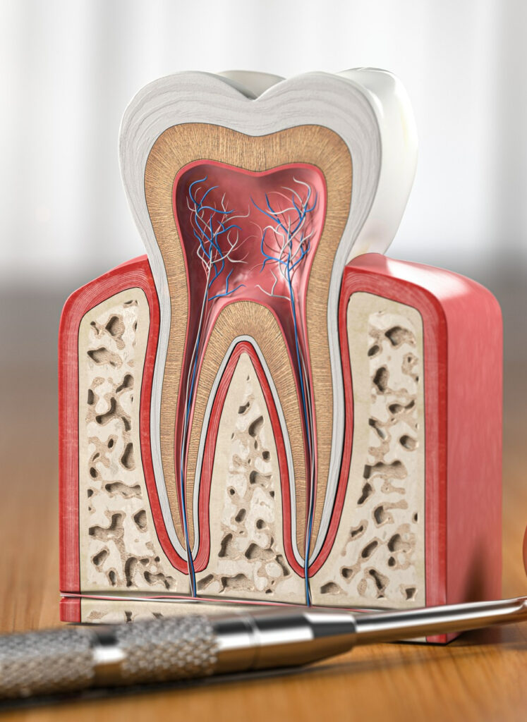 Лечение периодонтита