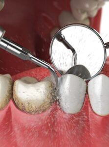 Ультразвуковая чистка зубов