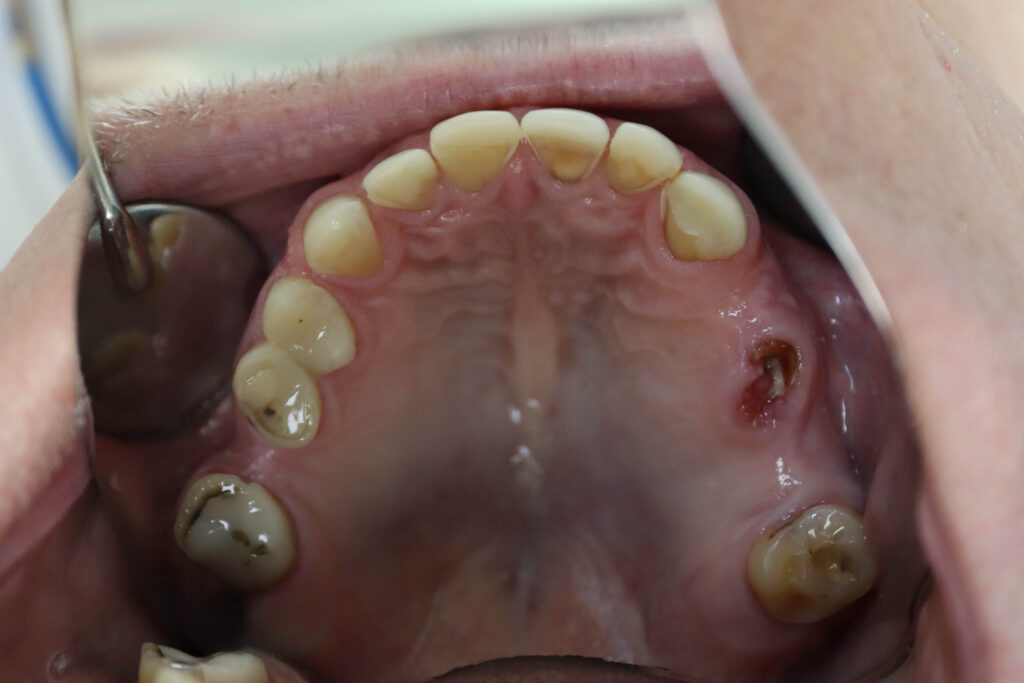 пациент до имплантации