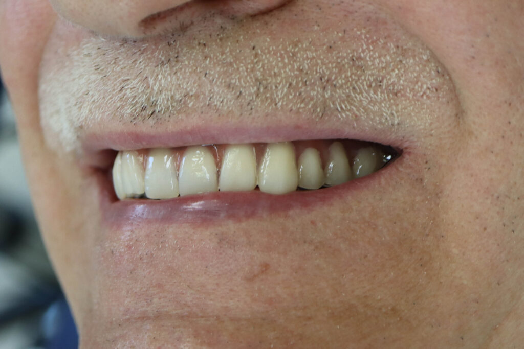 рузультат имплантации