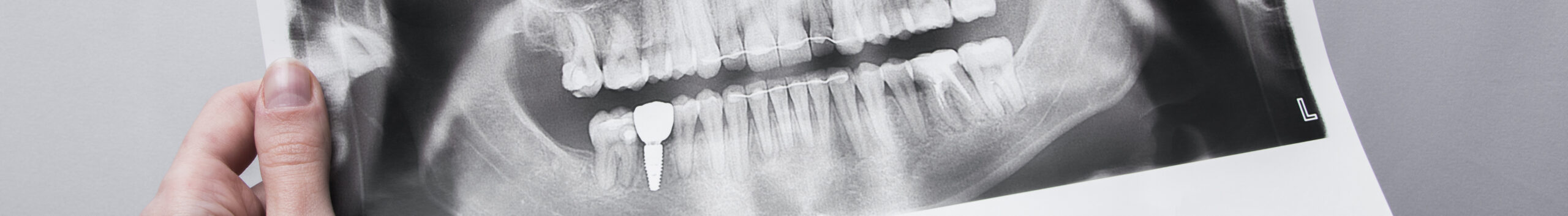имплантация