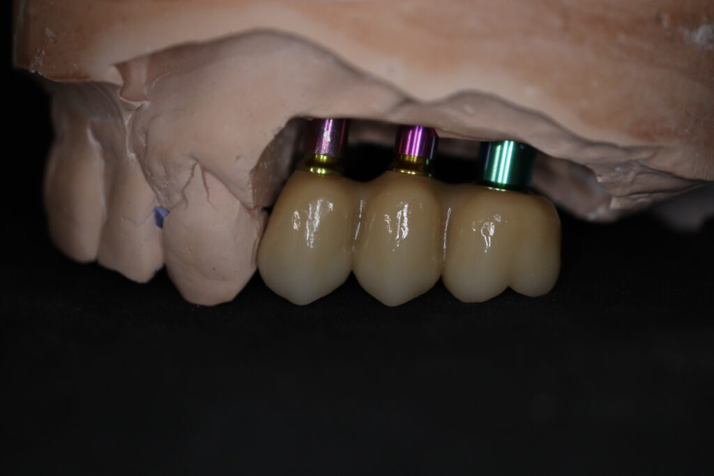 процесс протезирования