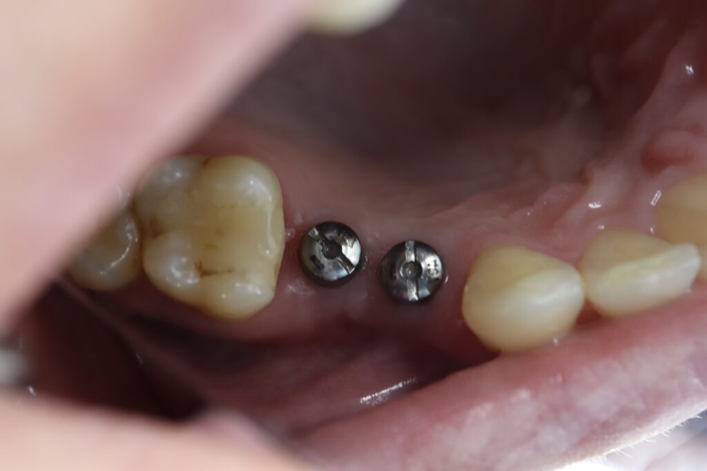 пациент до протезирования