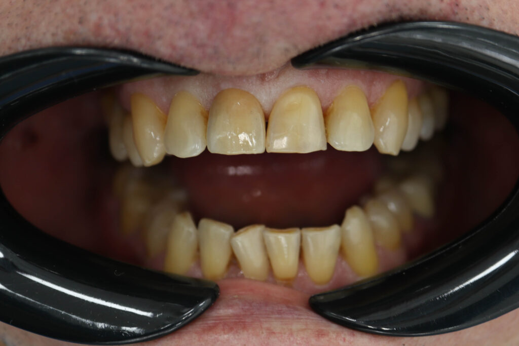 Установка керамической коронки Emax