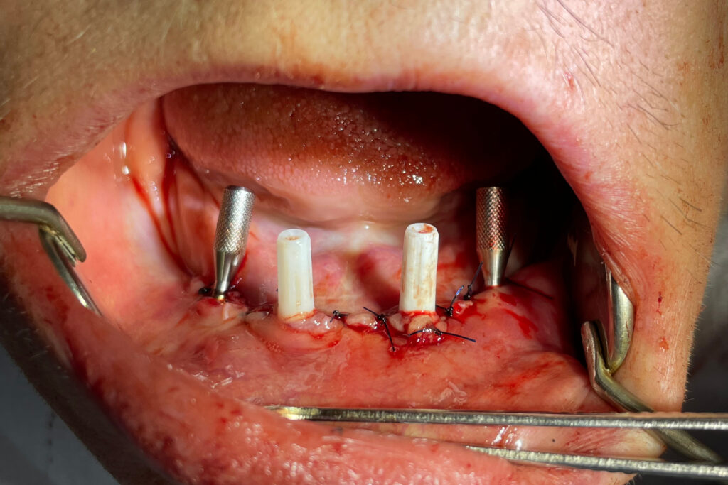 имплантация