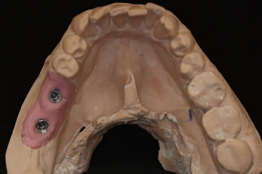 процесс протезирования