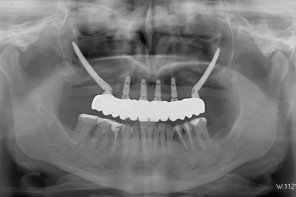 результат имплантации