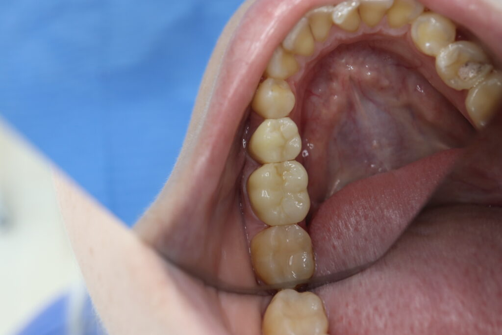 Протезирование коронками из диоксида циркония на своих зубах