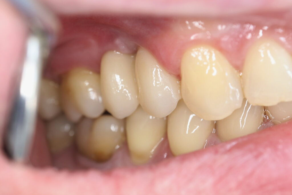 Протезирование мостом из диоксида циркония на винтовой фиксации с опорой на 2 имплантата Megagen AnyOne