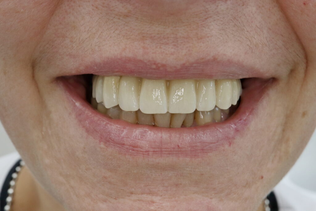 Протез из диоксида циркония на 6ти имплантатах