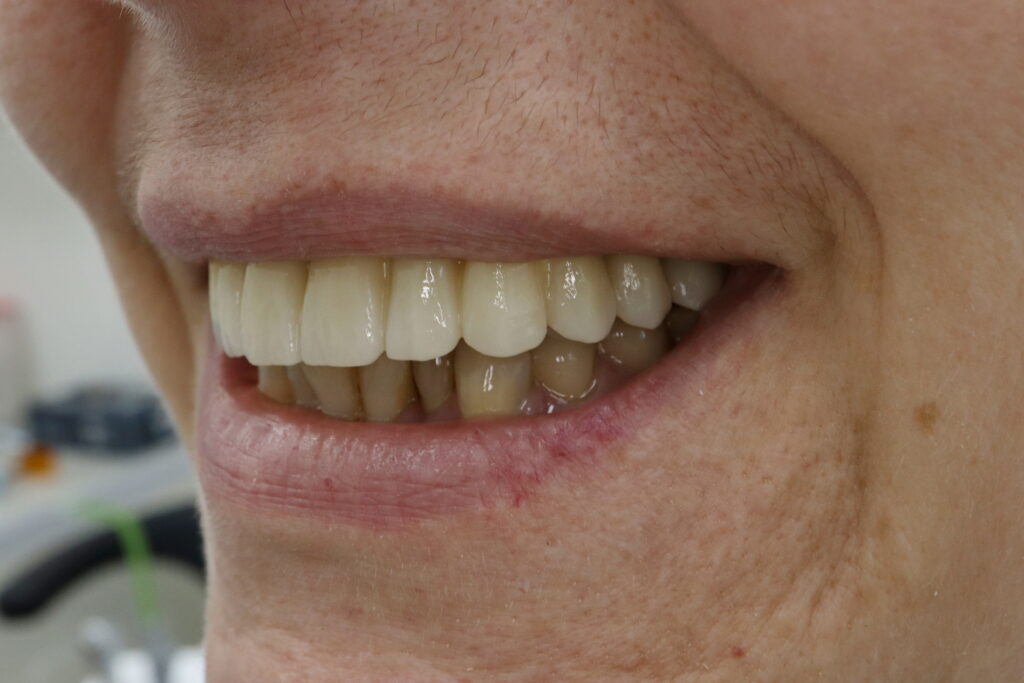 результат имплантации