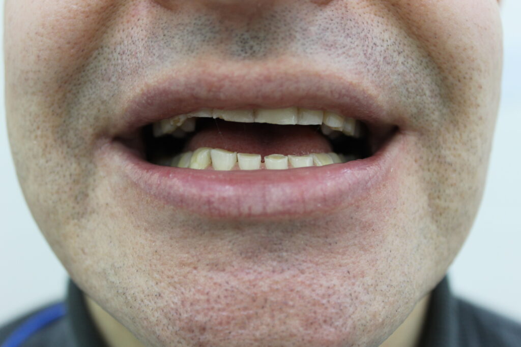 пациент до реставрации