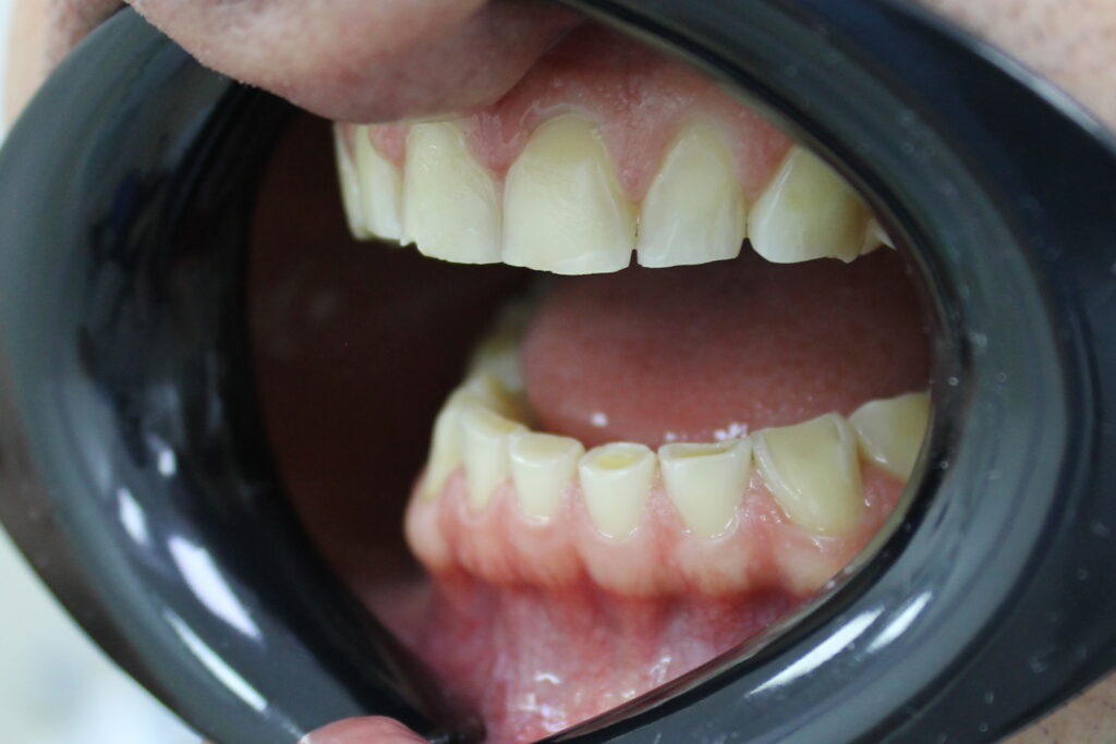 пациент до реставрации