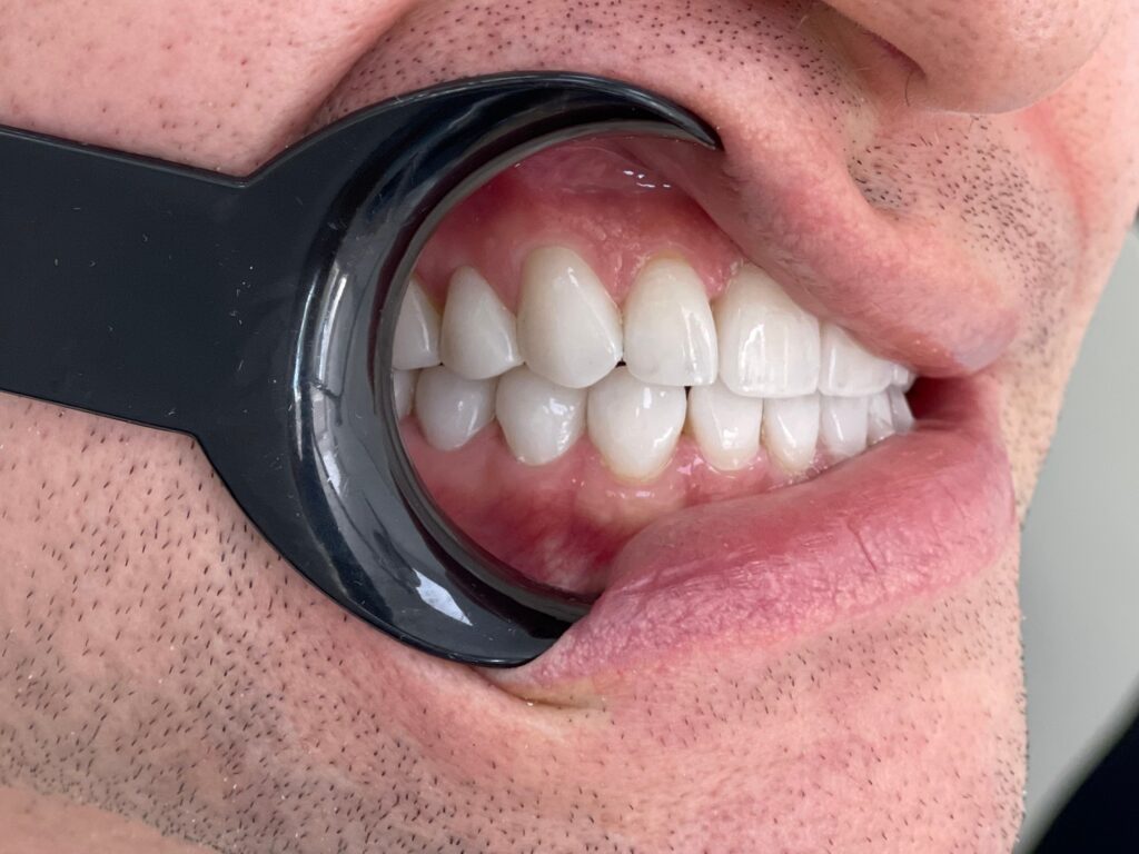 Результат реставрации зубов