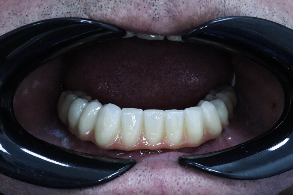 Диоксид циркония на 6ти Megagen AnyOne