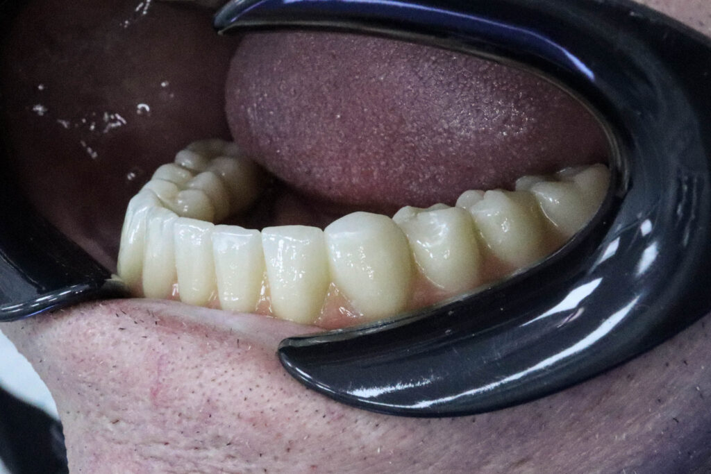 результат протезирования