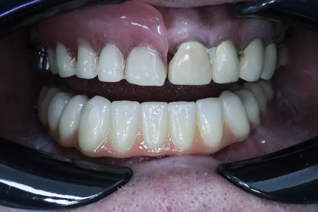 результат протезирования