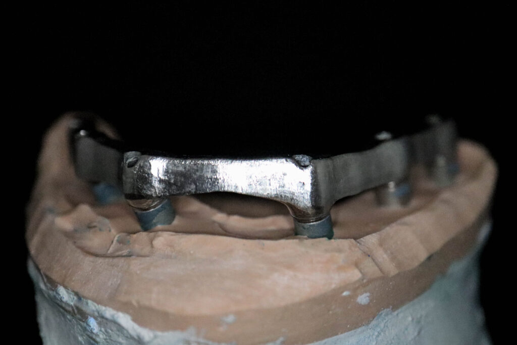 протезы перед установкой