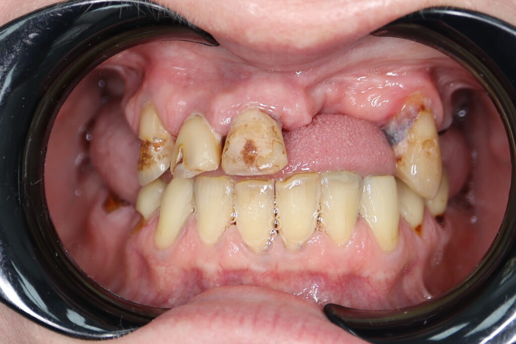 пациент до тотальной имплантации