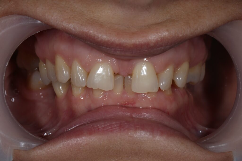 пациент до брекетов