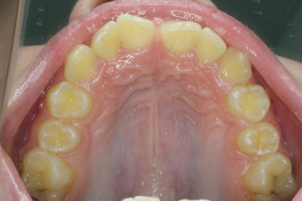 лечение брекет-системой