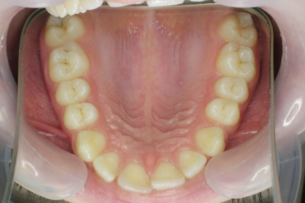 Ситуация до лечения брекетами