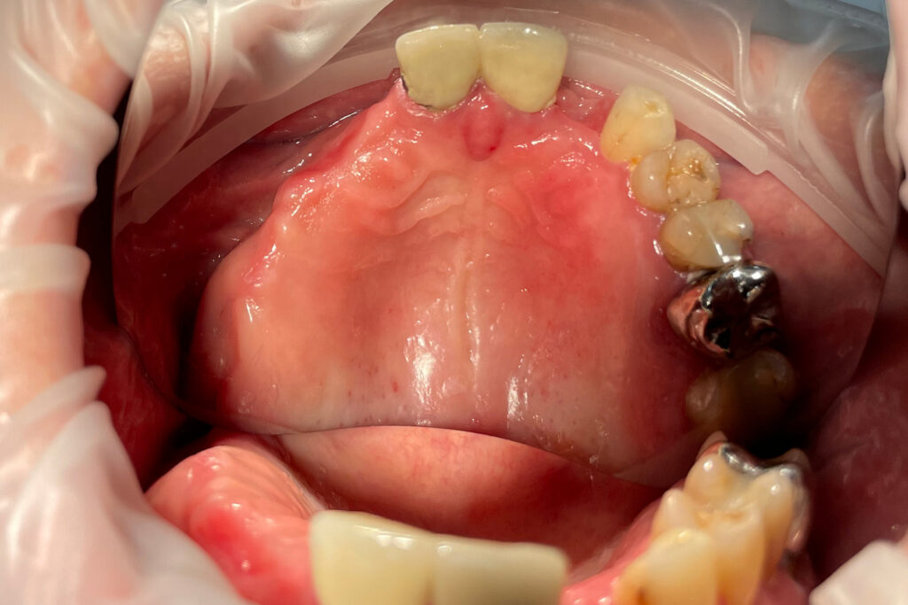 пациент до протезирования