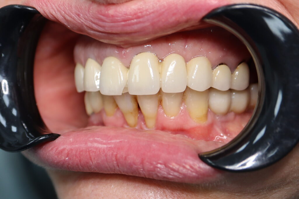 пациент до имплантации