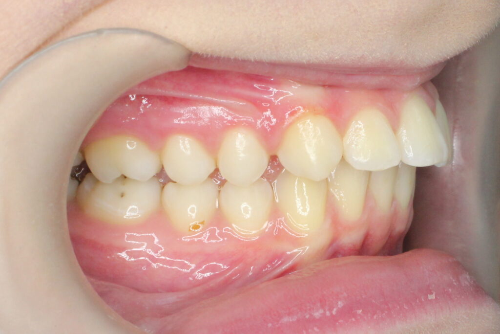 Ситуация до лечения брекетами