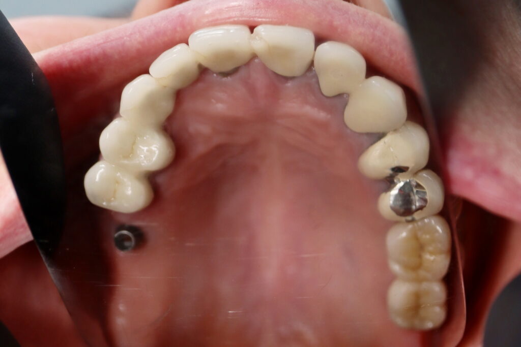 пациент до имплантации