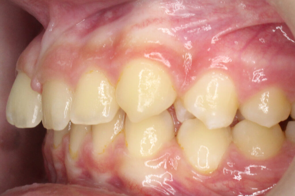 лечение брекет-системой