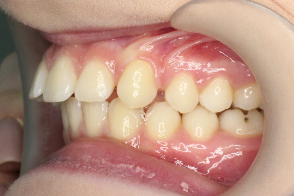 Ситуация до лечения брекетами