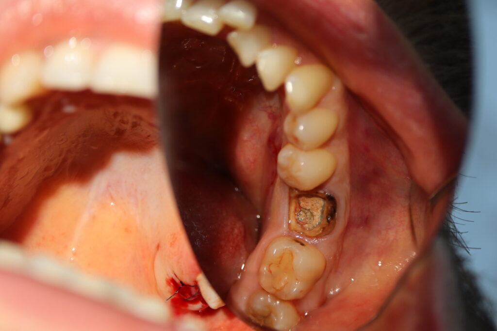 пациент до имплантации