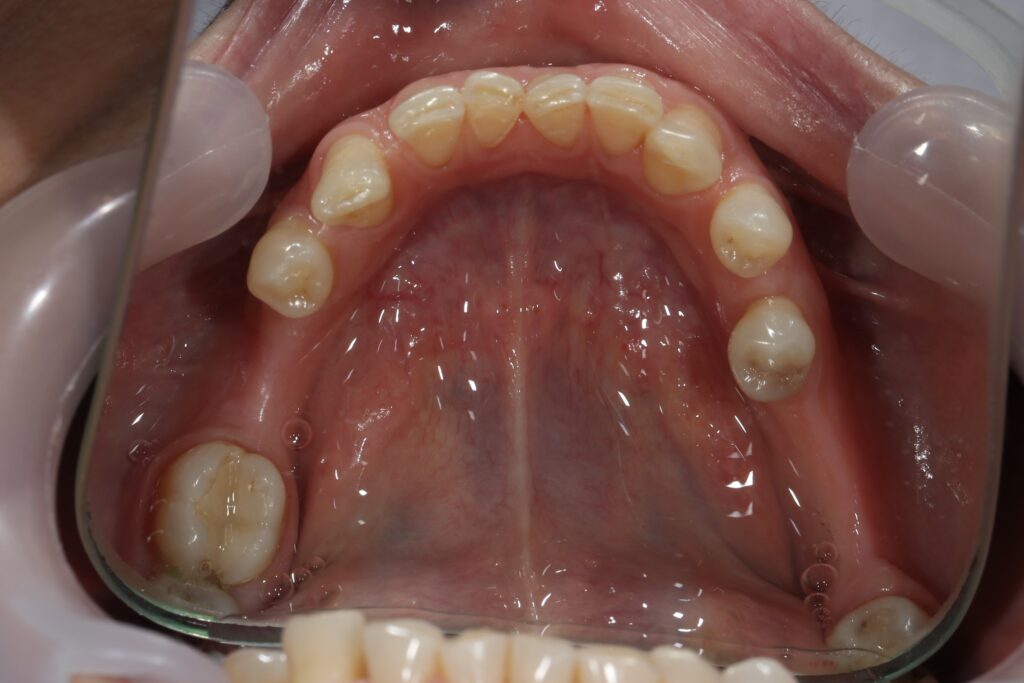 пациент до брекетов