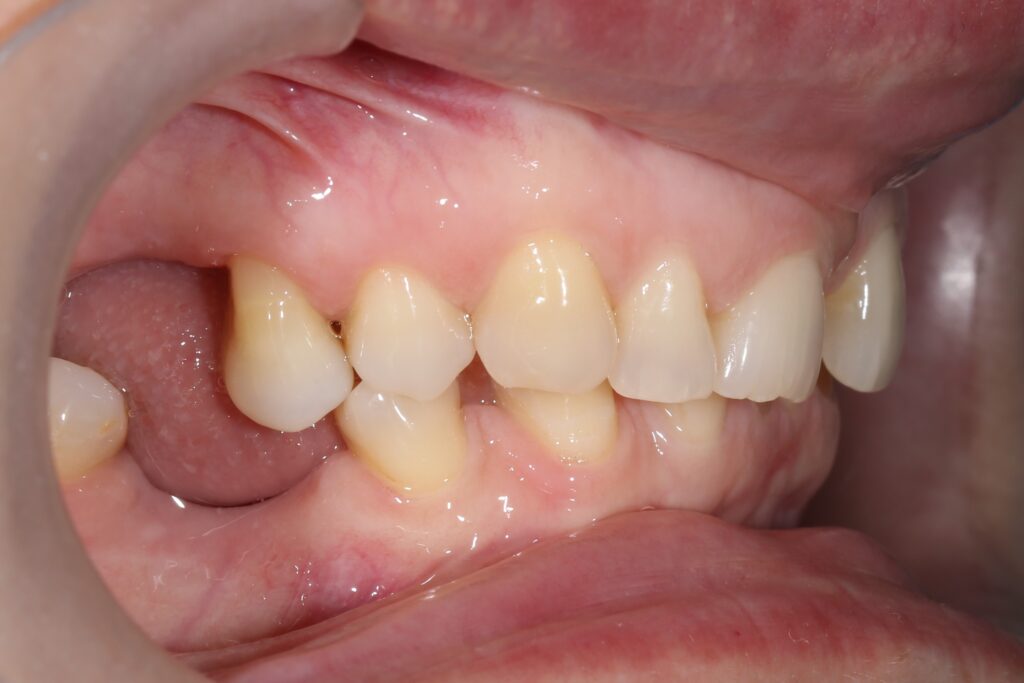 пациент до брекетов