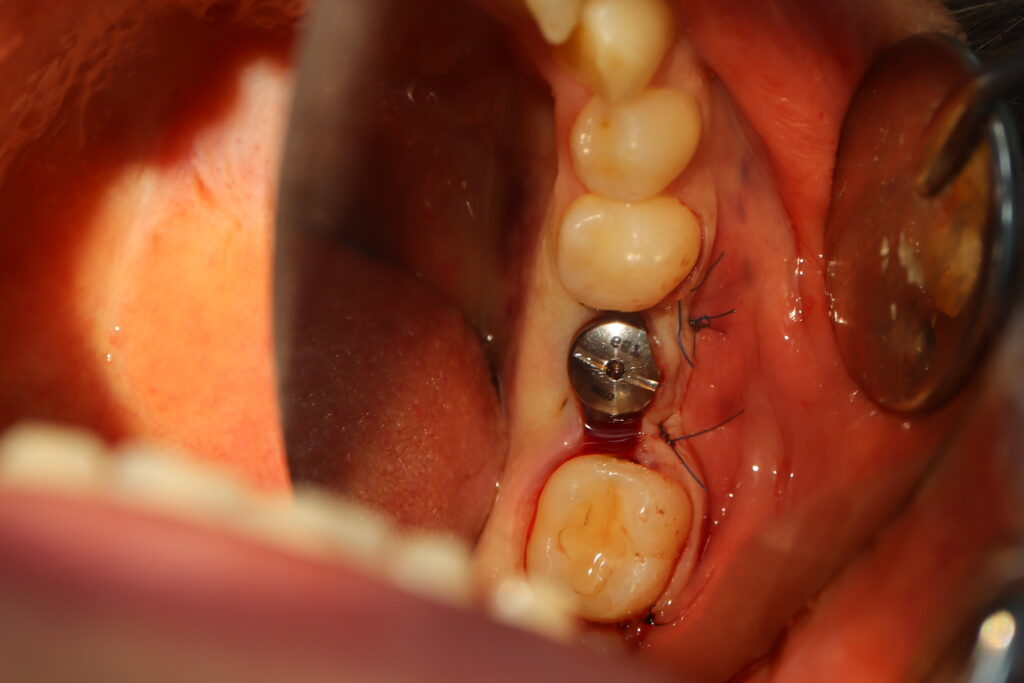 Одномоментная имплантация Megagen AnyOne