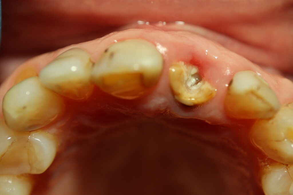 пациент до имплантации