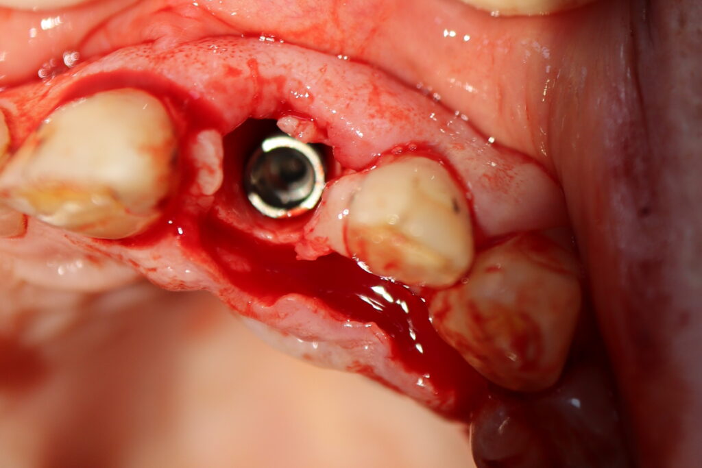 одномоментная имплантация