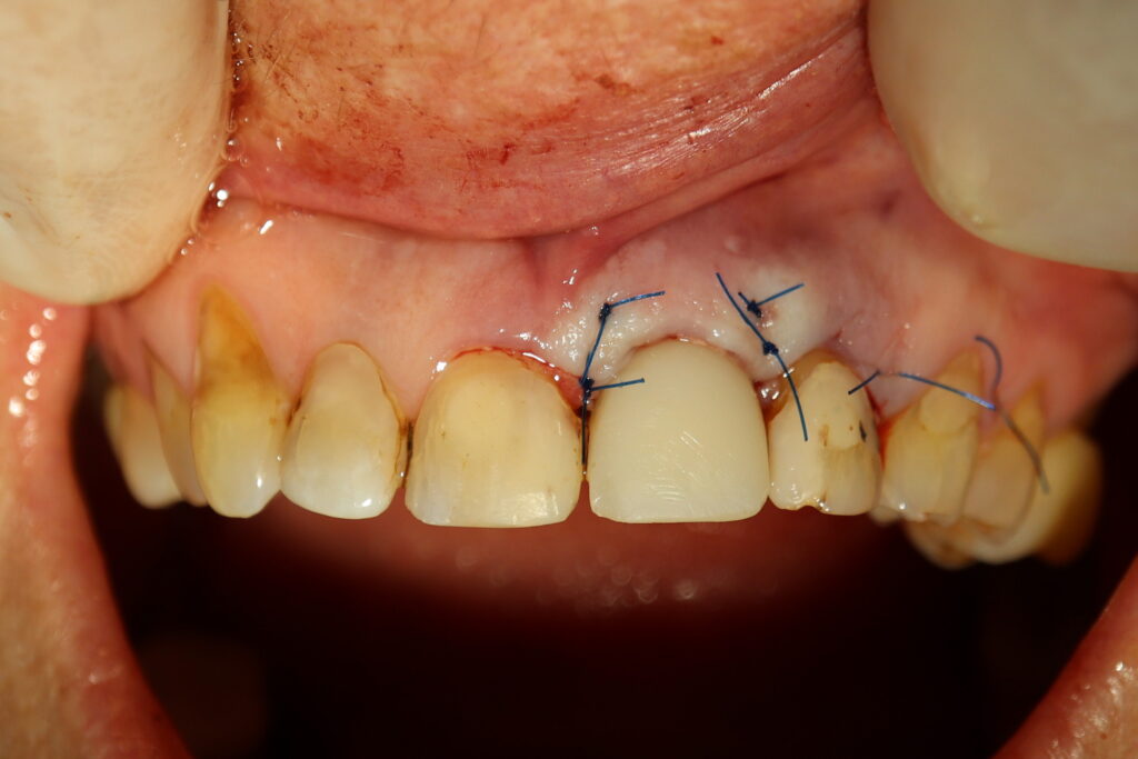 Одномоментная имплантация Megagen
