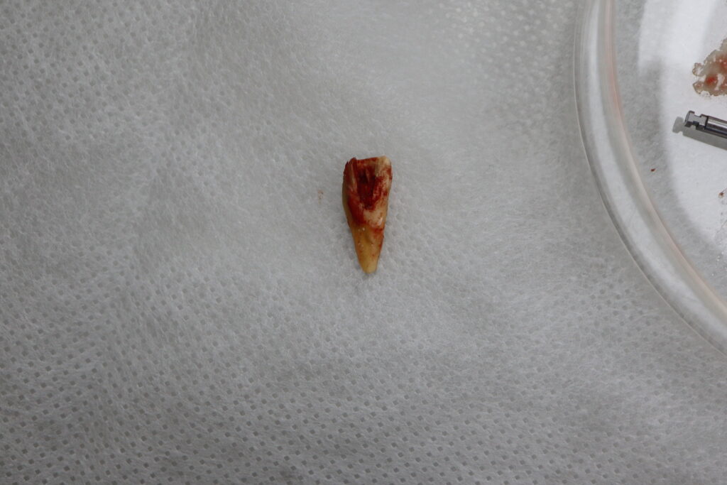 одномоментная имплантация