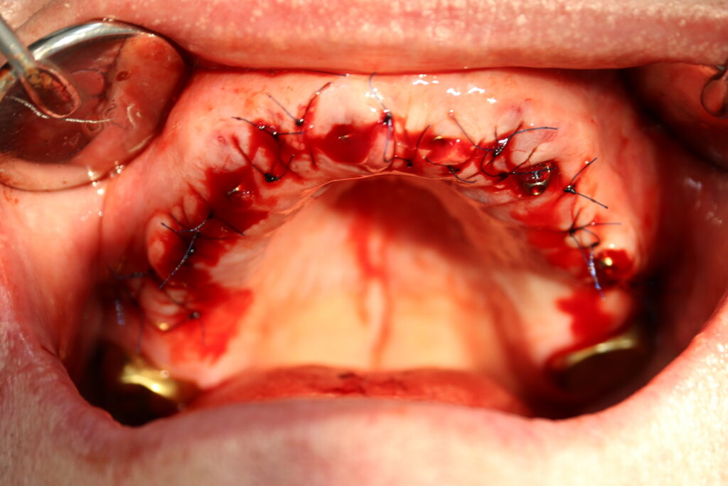 процесс имплантации