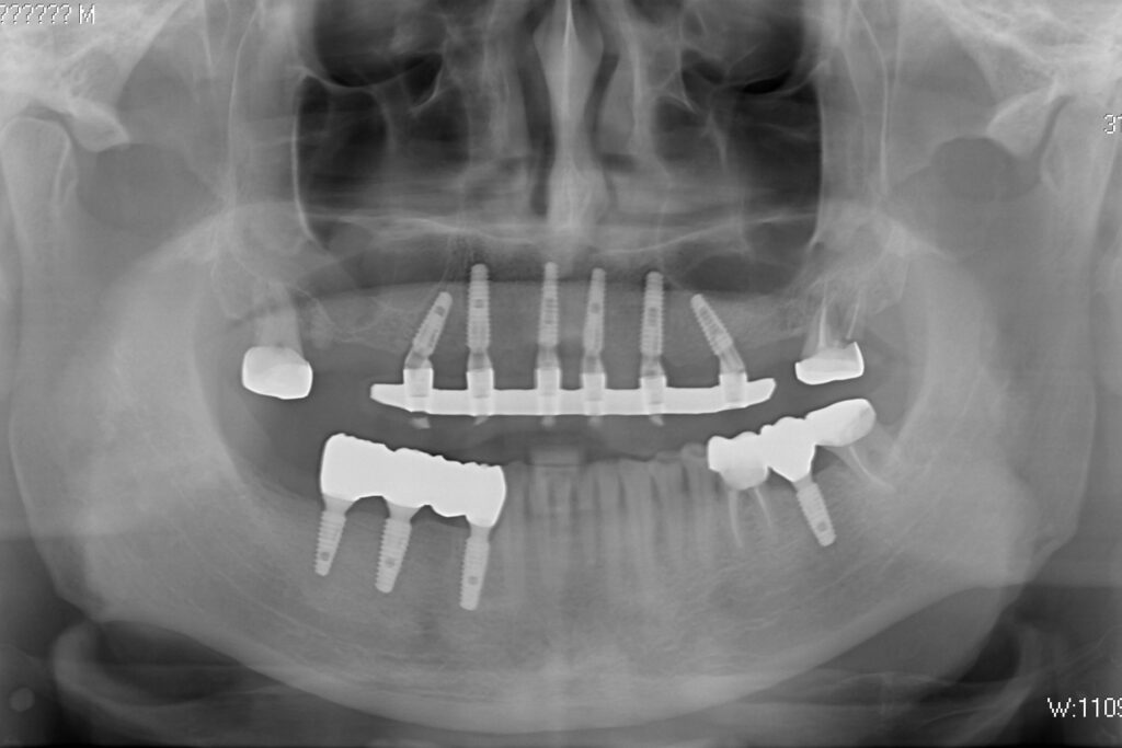 результат имплантации Megagen Anyone