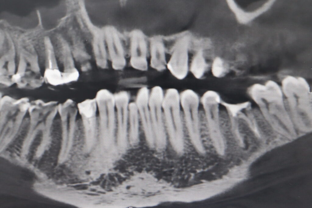 пациент до имплантации