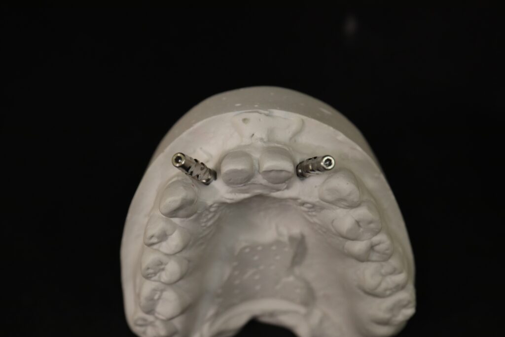 изготовление протеза